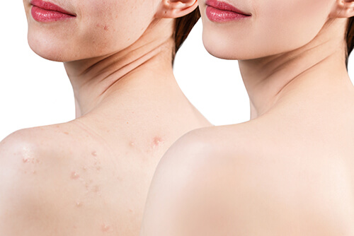acne