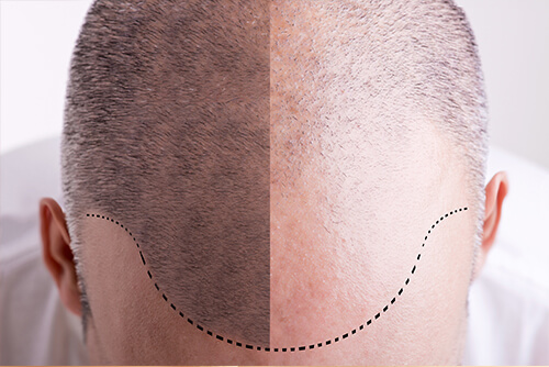 greffe-cheveux