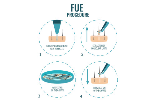 greffe-fue