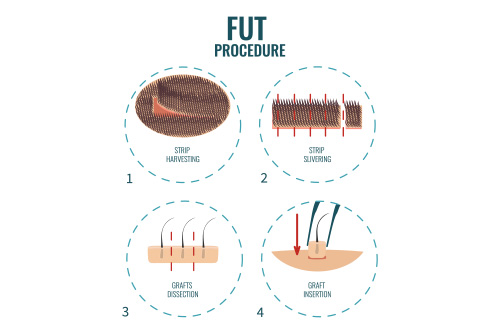 greffe-fut
