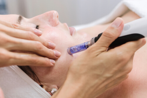 microneedling