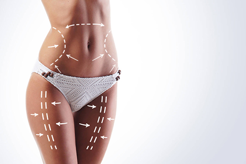 bodylift