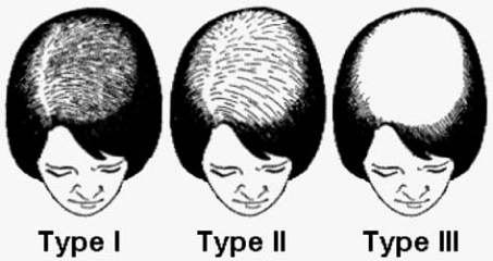 stade-alopecie_femme