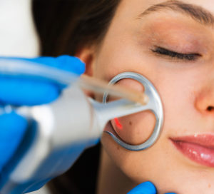Laser CO2 fractionné Lyon - Traitement CoolPeel au Centre Celest Villeurbanne